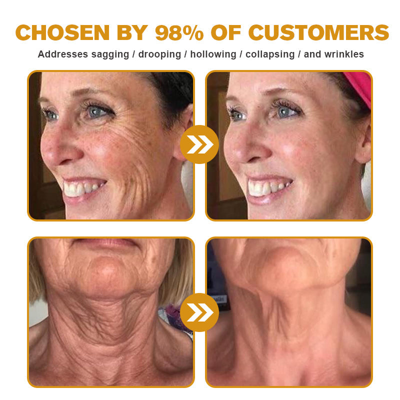 (Made and Shipped from USA✅) ADNOON®Botox Bee Venom Wrinkle Removal Cream- LAST DAY 80% OFF