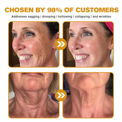 (Made and Shipped from USA✅) ADNOON®Botox Bee Venom Wrinkle Removal Cream- LAST DAY 80% OFF