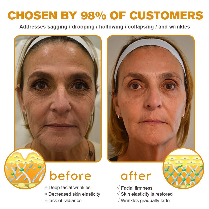 (Made and Shipped from USA✅) ADNOON®Botox Bee Venom Wrinkle Removal Cream- LAST DAY 80% OFF