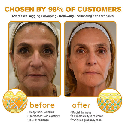 (Made and Shipped from USA✅) ADNOON®Botox Bee Venom Wrinkle Removal Cream- LAST DAY 80% OFF
